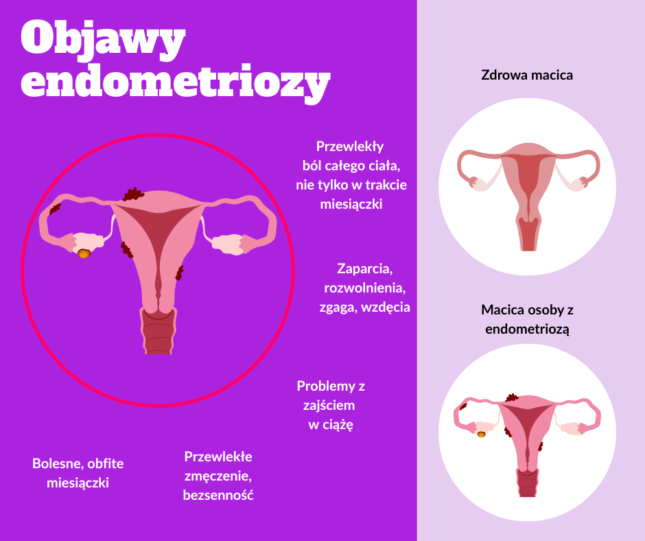 Jak zmieniło się moje życie po diagnozie endometriozy image
